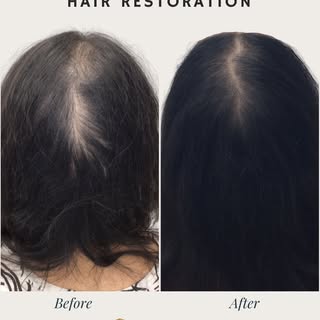 This is the result of Exosome Hair Restoration @torontohairtransplantcentre one of the most advanced