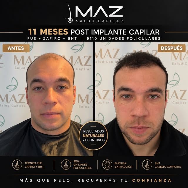 Cuando la zona donante no alcanza, hay que pensar más allá.

Este paciente presentaba una alopecia a