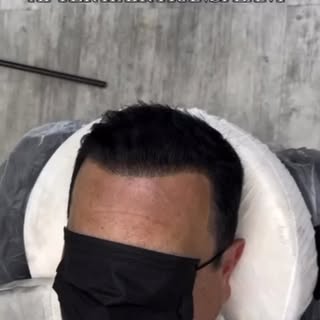 The perfect finishing touch after a hair transplant. 🔥
SMP adds the look of density for a fuller, m