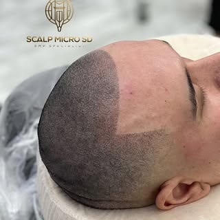 Still wondering if SMP is worth it?

This is what one session can do. 🔥

A natural-looking hairline