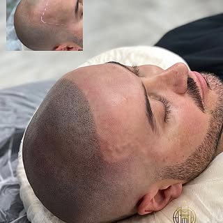 The right hairline doesn’t change who you are… it brings YOU back. 🔥

A natural-looking hairline ca