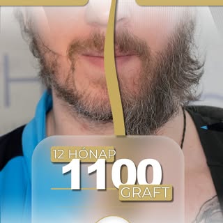🔥 Ilyet még nem látott 🔥
1100 graftos szakállbeültetés – precízió, sűrűség, karakter.

A dús, kara