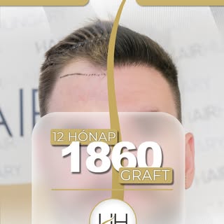 🔥Ehhez a videóhoz nem kell sok magyarázat

✨ 1860 graft… és mégis ekkora különbség! 🤯

Sokan azt h
