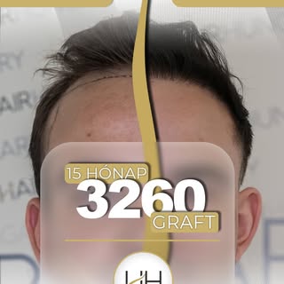 ✨ Mit adhat a hajbeültetés? ✨

💪 Férfias magabiztosság
🔥 Megerősödő önbizalom
🌿 Egészséget és erő