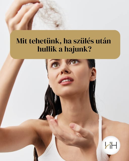 A szülés utáni hajhullás sok kismamát váratlanul ér, pedig a legtöbb esetben a hormonális változások