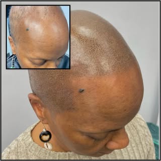 #scalpmicropigmentationwomen #femalescalpmicropigmentation#smp#alopeciatreatment#hairlosssolution