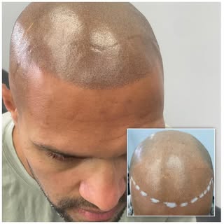 #hairtattoos#scalptattoo #scalpmicopigmentationmen#micropigmentation#smp