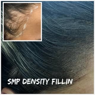 #scalpmicropigmentation#thinninghairsolution#tractionalopecia#smp#thinning-hairtreatment#femalescalp