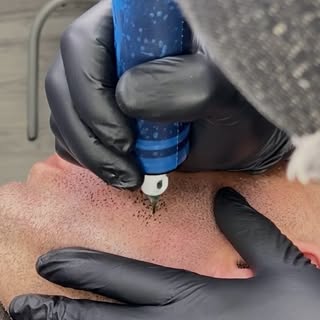 #beardtattoo#smp#scalpmicropigmentationbeard#facetattoo