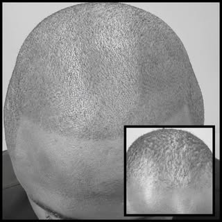 #hairlinetattoo#smp#scalpmicropigmentation#hairtattoo#scalptattooing