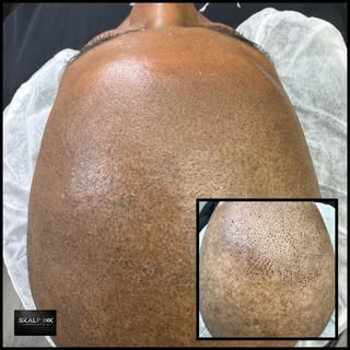 #smp#scalpmicro#alopecia#alopeciasolutions#hairrestoration