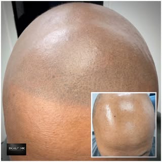 #smp#scalpmicropigmentation#hairlinetattoo #hairtattoos#hairreplacement