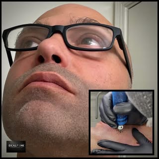 #beardtattoo#scalpmicropigmentation#beard#hairtattoo