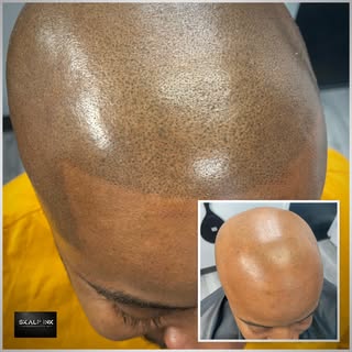 #smp#scalptattoo#hairtattoos#hairreplacementspecialist#micropigmentation