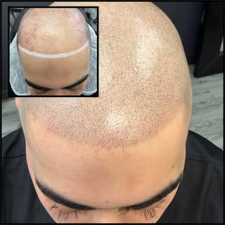 #smp #hairtattoo #scalpmicropigmentation #scalptattooing #hairrestoration