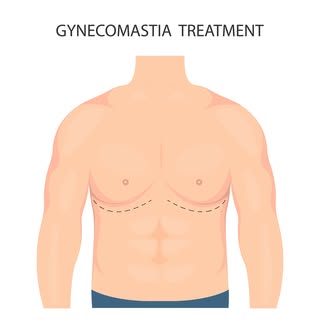 Gynaecomastia Surgery in Bengaluru

Many men hesitate to talk about changes in their chest appearanc