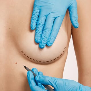 Breast Augmentation in Bengaluru: What to Know Before Considering Surgery

Breast augmentation is a 