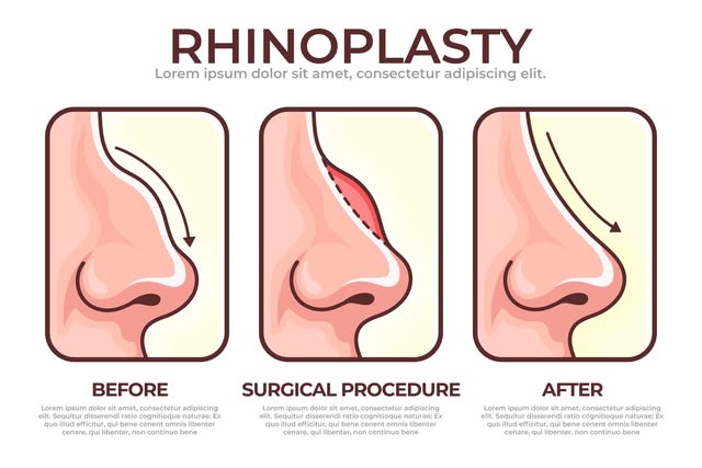 Rhinoplasty Consultation in Bengaluru: 10 Questions Worth Asking Before Surgery

Deciding to undergo