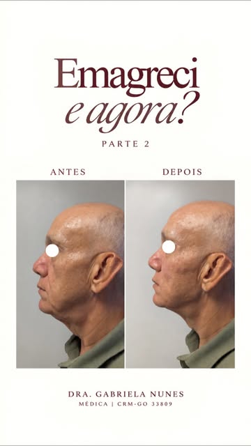 Na Parte 1, mostrei como utilizamos o ácido hialurônico para devolver suporte e estrutura ao rosto a