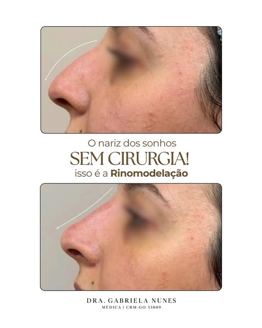 Um resultado que respeita o rosto e valoriza o perfil. 

A rinomodelação com ácido hialurônico permi