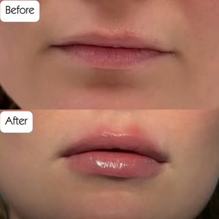 If you look better but no one can tell why…we understood the assignment 💉

Subtle lip enhancement u