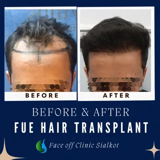 Where expertise meets real, visible results ✨

At Face Off Clinic, we specialize in FUE Hair Transpl