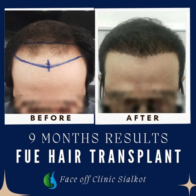 9 months of growth. A fuller look that makes the difference. ✨

These before-and-after results show 