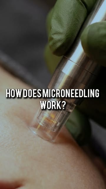 Microneedling works by creating tiny, controlled micro-channels in the skin to stimulate the skin’s 
