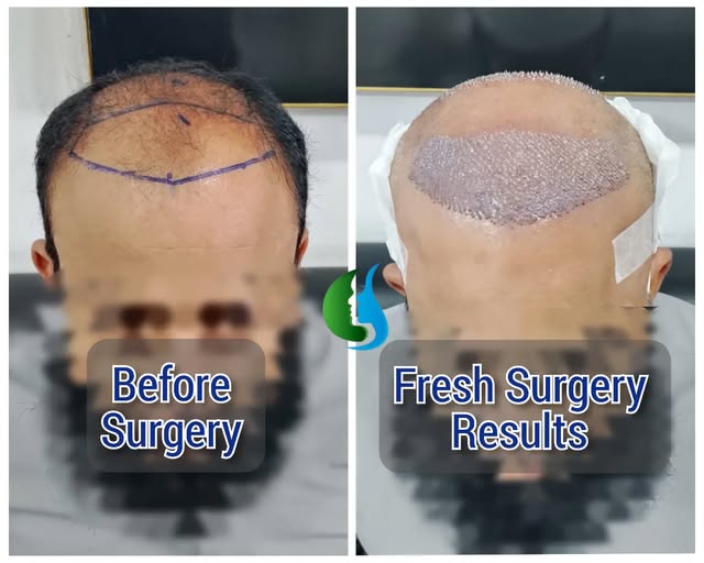 Fresh FUE Hair Transplant results ✨

This procedure focused on the hairline and crown area, aiming t