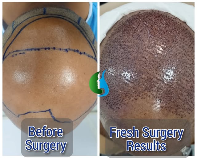 Fresh FUE Hair Transplant results ✨

This procedure focused on the crown area, aiming to improve cov