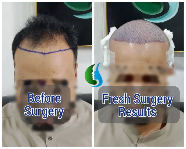 Fresh FUE Hair Transplant results ✨

A fresh FUE Hair Transplant focused on the hairline and crown a