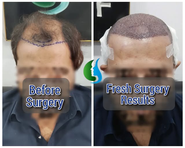 Fresh FUE Hair Transplant results ✨

A fresh FUE Hair Transplant focused on the hairline and mid-sca