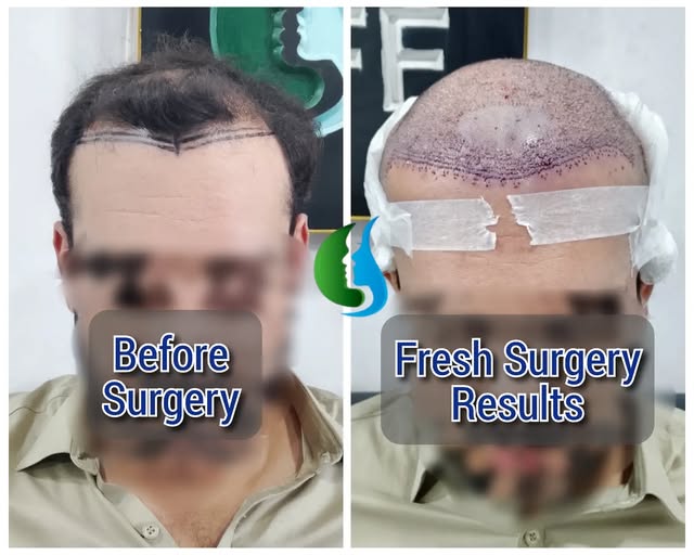 A new hairline. A fresh start. ✨

FUE Hair Transplant focused on restoring the hairline with a natur