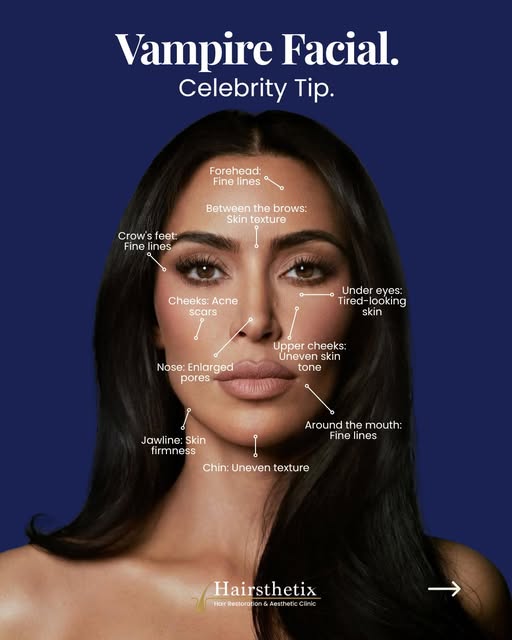 If you've been curious about Vampire Facials, here's what actually happens during the treatment. 🩸✨