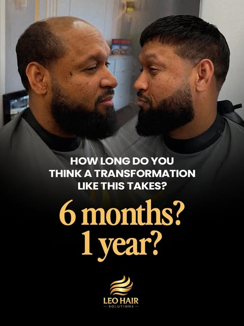 A transformation like this doesn’t have to take months.

With the right Hair System, professional ap