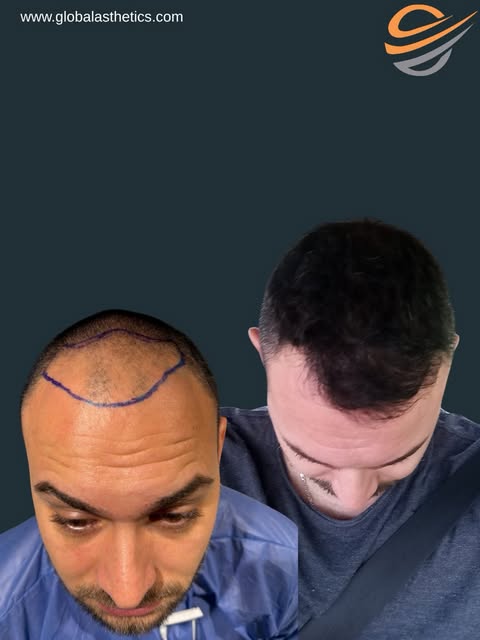 Želite saznati jeste li kandidat za transplantaciju kose?
Pošaljite nam fotografije svoje kose u DM 