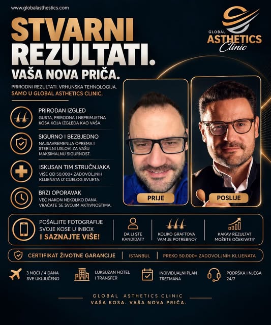 U GLOBAL ASTHETICS CLINIC svaki pacijent dobija individualan plan, prirodno dizajniranu liniju kose 