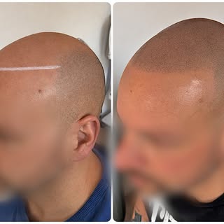 ✨ Avant / Après – Tricopigmentation effet crâne rasé

Résultat obtenu après 3 séances de tricopigmen