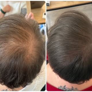✨ Avant / Après – Tricopigmentation femme ✨

Après ses grossesses, elle a vu sa chevelure changer…
U