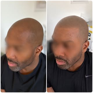 ✨ Avant / Après – Effet crâne rasé sur peau riche en mélanine ✨

La tricopigmentation s’adapte à tou