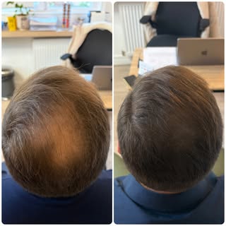 La micropigmentation capillaire, aussi appelée tricopigmentation, est aujourd’hui l’une des solution