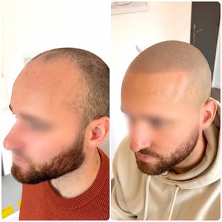 ✨ Avant / Après – Tricopigmentation effet crâne rasé ✨

Parfois, quelques milliers de micro-impacts 