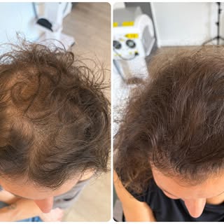 ✨ Quand la tricopigmentation redonne confiance.

Chaque cuir chevelu est unique. Ici, l’objectif n’é