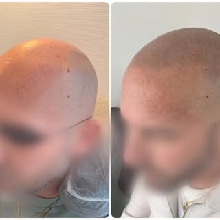 Le naturel avant tout.

Mon objectif n’est pas de faire une tricopigmentation qui impressionne le jo