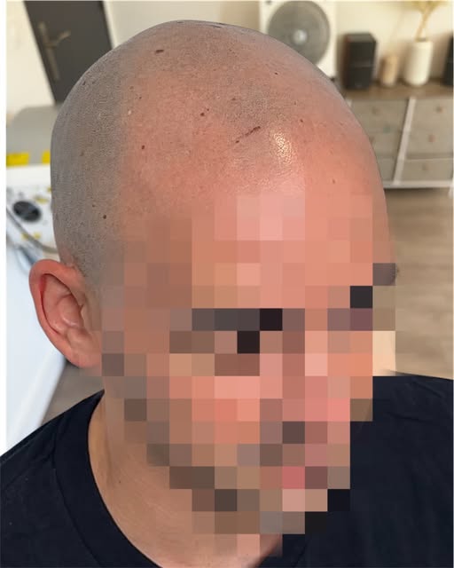 AVANT ➜ APRÈS 🔥

L’objectif ici n’était pas de créer une pigmentation qui se remarque… mais justeme
