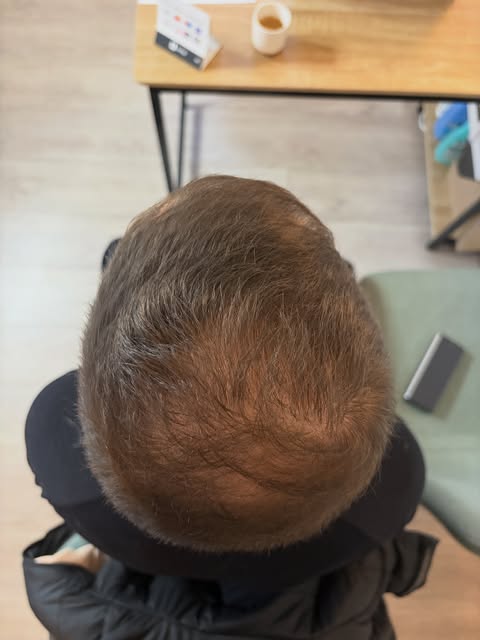 🔎 VERTEX COMBLÉ EN TRICOPIGMENTATION 
 ➡️Resultat 1 an après ! 🪄

Ce client est revenu me voir pre