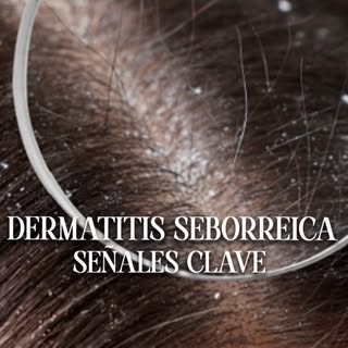 🧴 Así puede verse una dermatitis seborreica cuando alcanza un grado importante.

No se trata solo d