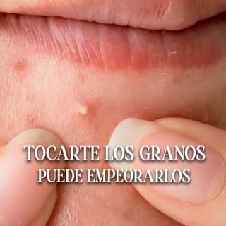 👀 Seguro que alguna vez has hecho esto: ves un granito y empiezas a tocarlo… y acabas explotándolos