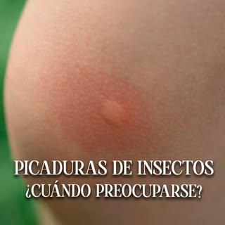 🦟 Mosquitos, mosquitos tigre, tábanos, avispas… En verano aumentan las picaduras de insectos y, aun