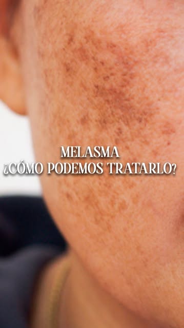 ☀️ Esto no son manchas de sol sin más. Y no, ninguna crema milagrosa va a borrarlas de un día para o